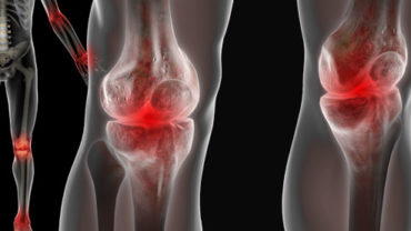 Homeopathy Treatment for Joint Pain