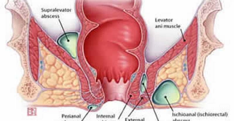 Naturopathy – Anorectal disease – Fissures, Fistulae