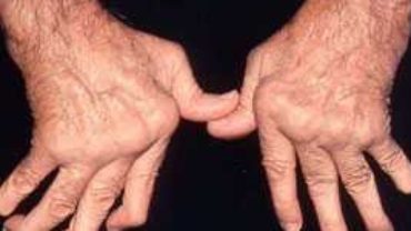 Naturopathy Treatment for Arthritis, Rheumatism, Prevention and Treatment – 2