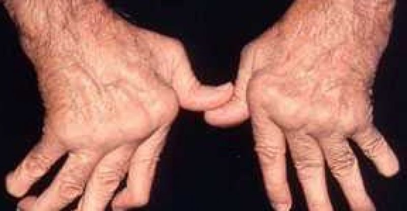 Naturopathy Treatment for Arthritis, Rheumatism, Prevention and Treatment – 2 Naturopathy Treatment for Arthritis, Rheumatism, Prevention and Treatment – 2