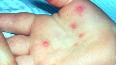 Naturopathy – Jauntice Hepatitis Types, Causes, Symptoms