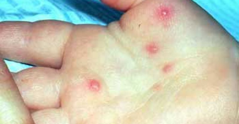 Naturopathy – Jauntice Hepatitis Types, Causes, Symptoms