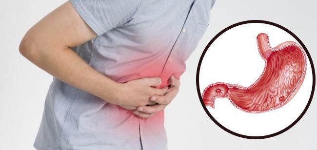 Homeopathic Medicine for Ulcers