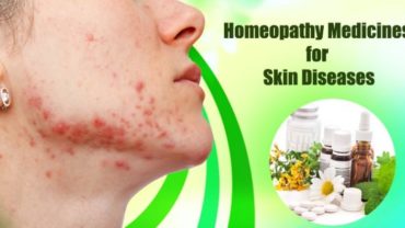 10 Amazing Homeopathic Medicine for Various Skin Diseases