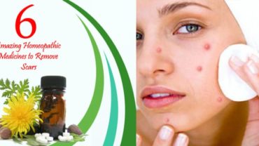 6 Amazing Homeopathic Medicines To Remove Scars