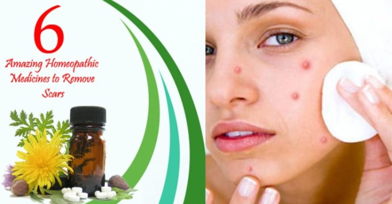 6 Amazing Homeopathic Medicines To Remove Scars