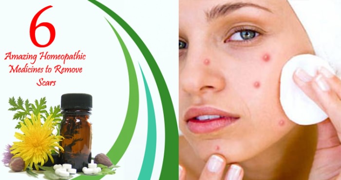 6 Amazing Homeopathic Medicines To Remove Scars 1 homeopathic medicines to remove scars