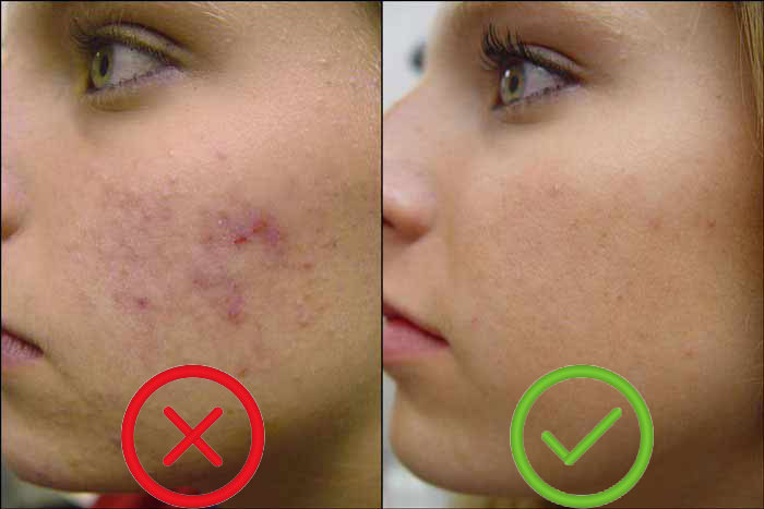 12 Effective Homeopathic Medicines For Cure Pimples 1